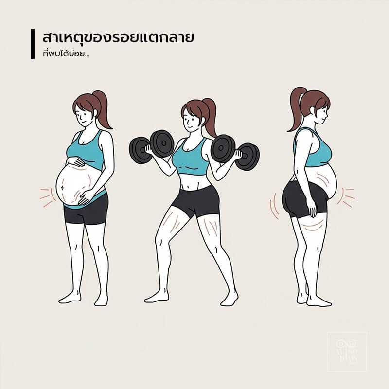 สาเหตุของรอยแตกลายที่พบได้บ่อย
