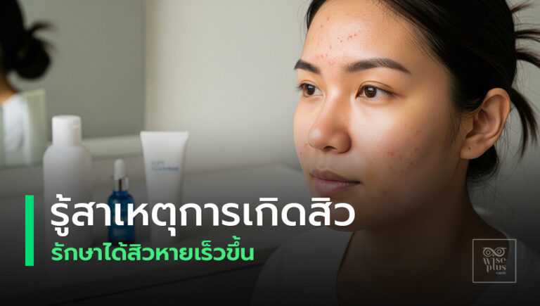 คู่มือสาเหตุและวิธีรักษาสิวฉบับง่ายได้ผล