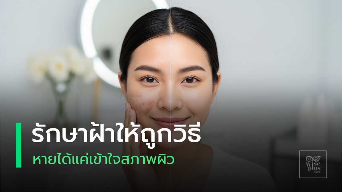 วิธีรักษาฝ้าให้ถูกวิธี พร้อมผิวกระจ่างใสอย่างปลอดภัย