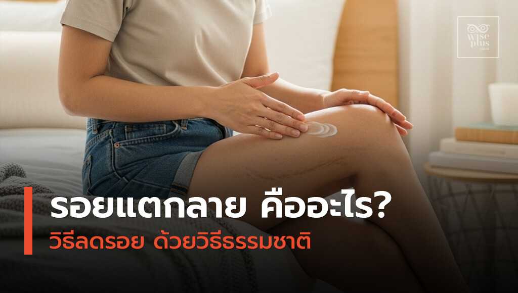 รอยแตกลายและวิธีลดรอยด้วยวิธีธรรมชาติ