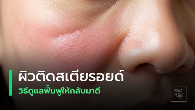 ผิวติดสเตียรอยด์แดงและอ่อนแอ
