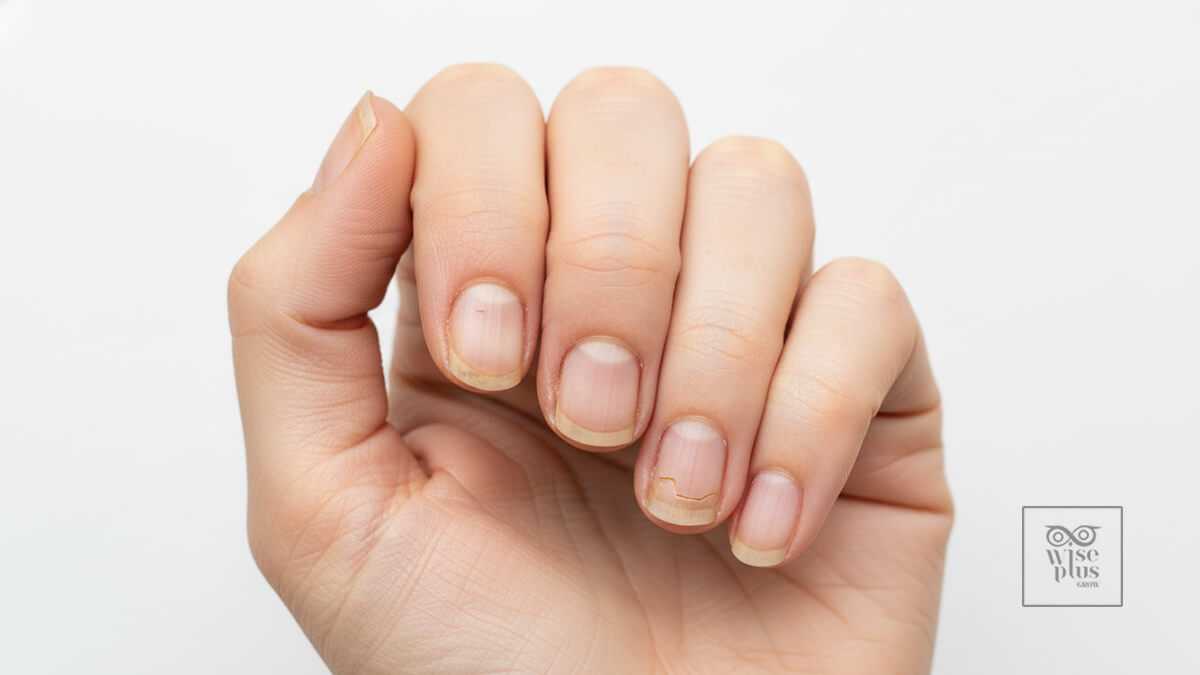 ล้างมือบ่อยทำให้เล็บแห้งและเปราะง่าย