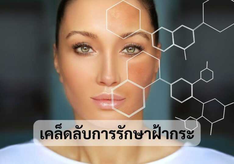 เคล็ดลับการรักษาฝ้ากระ