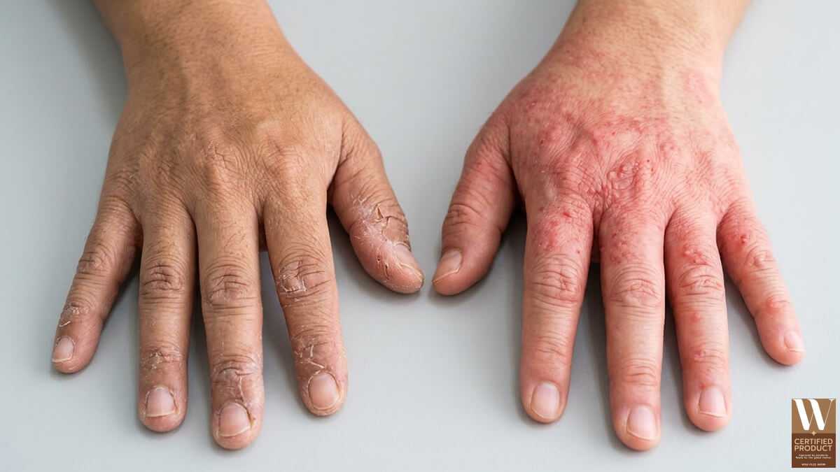 ความแตกต่างระหว่างผิวระคายเคืองกับผื่นแพ้สัมผัสจากสารทำความสะอาดบนผิวมือ