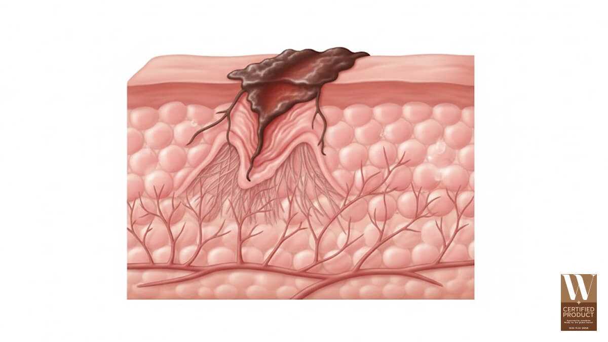 กลไกการเกิดสะเก็ดและการสมานแผล