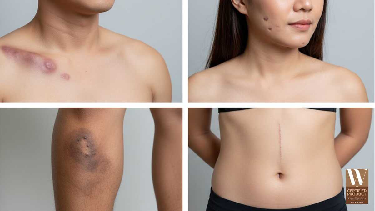 ลักษณะของรอยแผลเป็นเก่าที่ควรใช้ครีมเฉพาะทาง