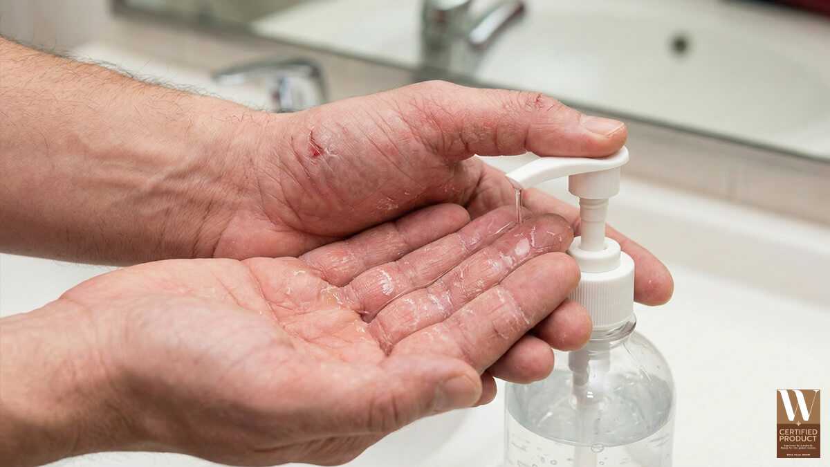 ผลของการใช้แอลกอฮอล์ต่อความแห้งของผิวมือและเกราะผิว
