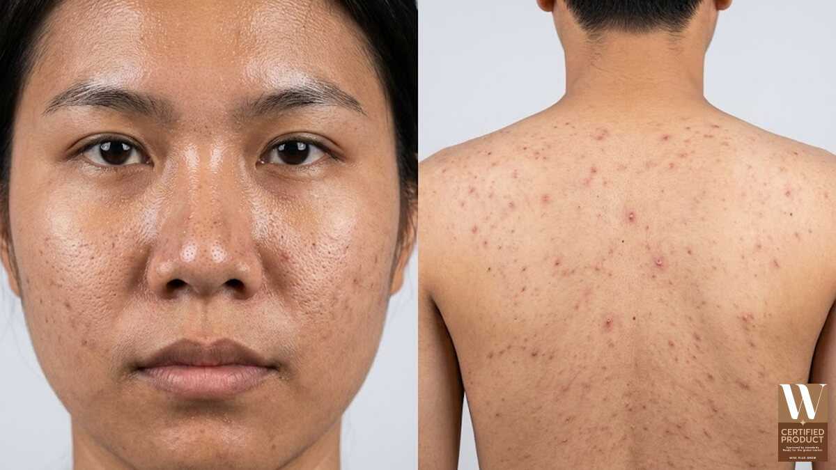 ปัญหาผิวมันรูขุมขนกว้างและสิวที่หลังเป้าหมายของสบู่โคลนภูเขาไฟฟูจิ