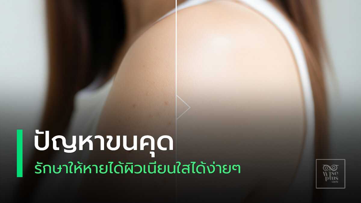 ผิวเรียบเนียนไร้ขนคุดด้วยวิธีธรรมชาติ