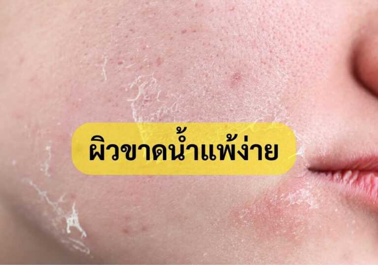 ผิวขาดน้ำแพ้ง่าย