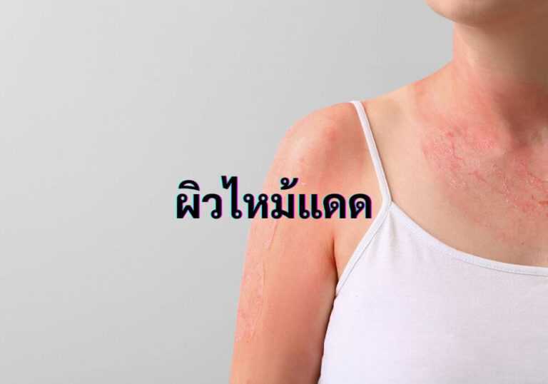 ผิวไหม้แดด