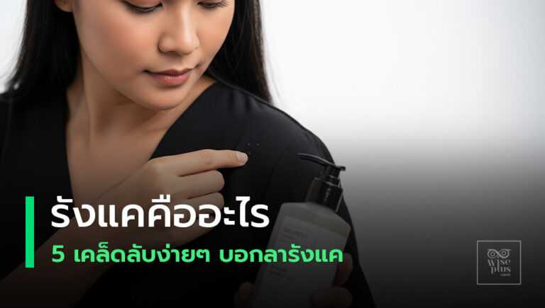 รังแคคืออะไรและวิธีแก้ง่ายๆ