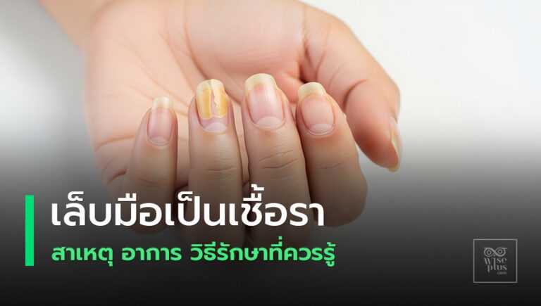 เล็บมือเป็นเชื้อรา สีเหลือง หนา แตกง่าย