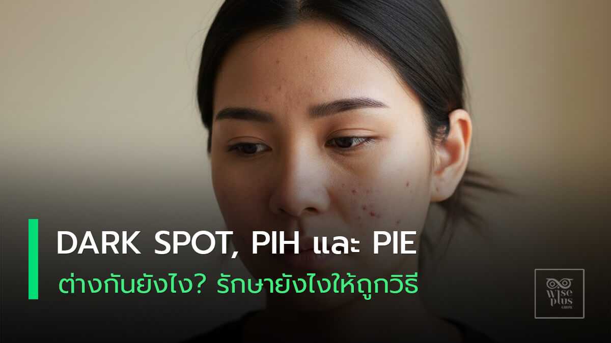 รอยสิว 3 แบบ Dark Spot PIH และ PIE บนผิวหน้า