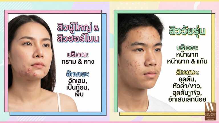 ความแตกต่างของสิวผู้ใหญ่ สิวฮอร์โมน และสิววัยรุ่น พร้อมแนวทางดูแลผิวให้เหมาะกับแต่ละช่วงวัย