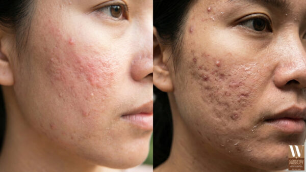 ผิวแพ้กับผิวพังต่างกันยังไง อาการคล้ายกันแต่วิธีแก้ไม่เหมือนกัน