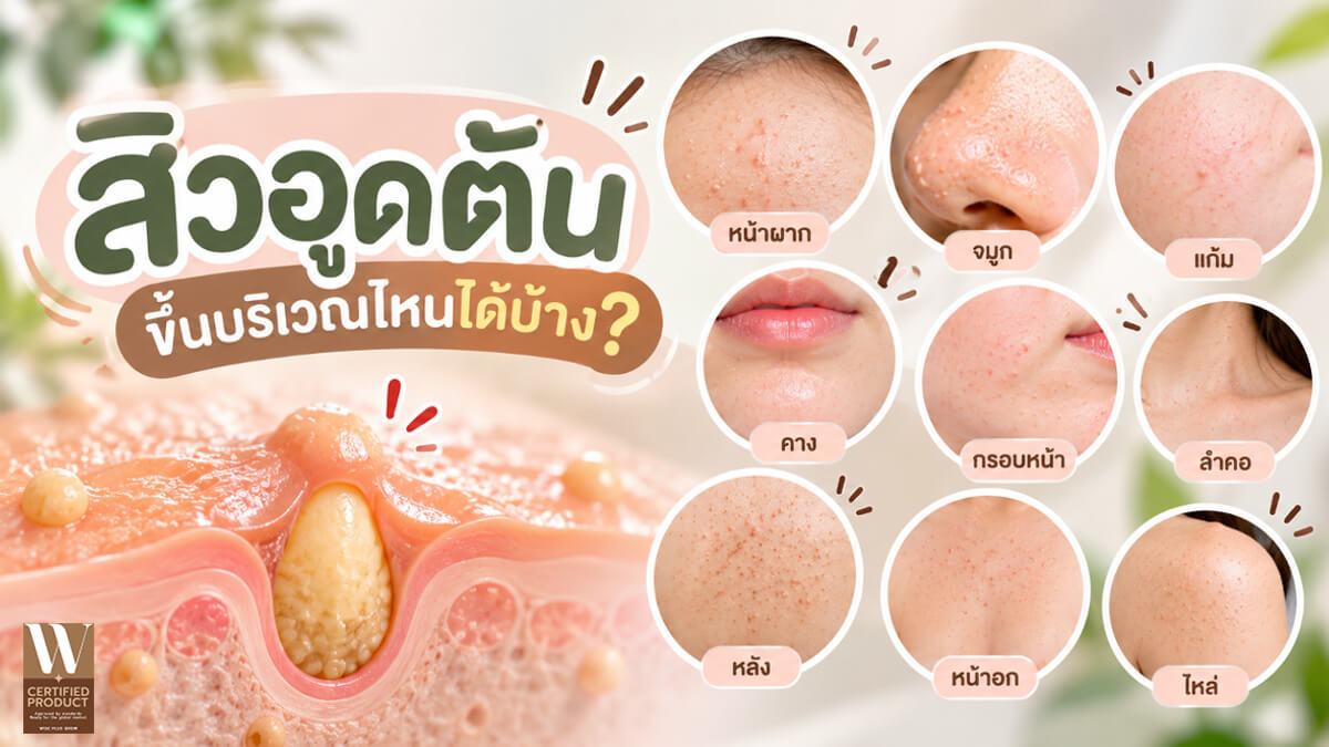 บริเวณที่พบบ่อยของสิวอุดตันบนใบหน้าและผิวหนัง