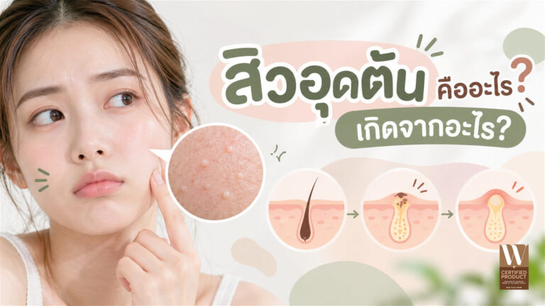 สิวอุดตันและสาเหตุการเกิดสิวจากรูขุมขนอุดตัน